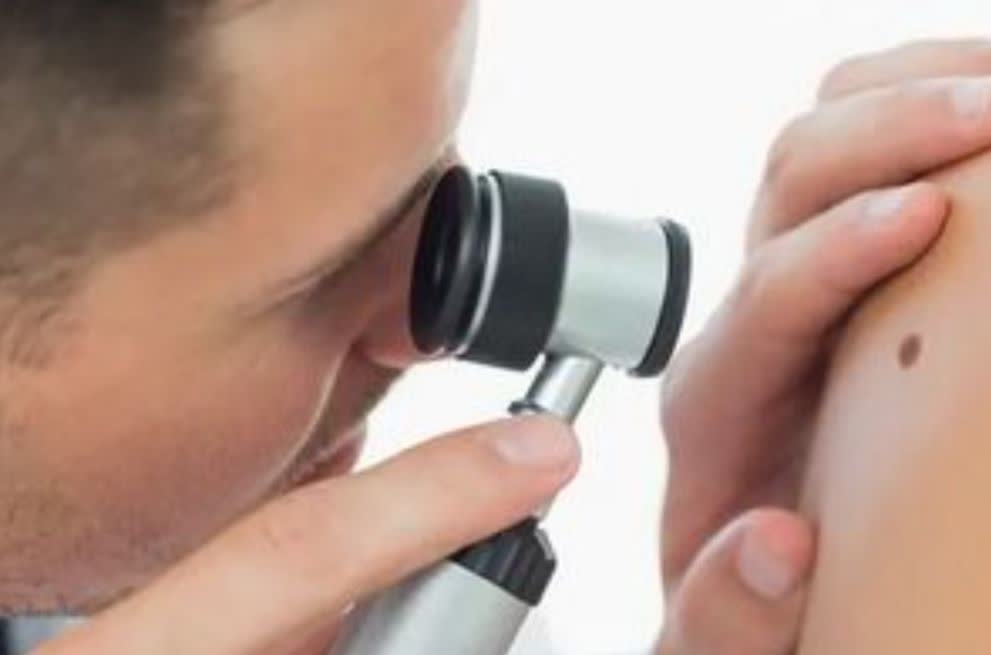 برداشتن خال