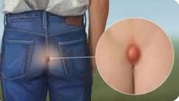 کیست موئی یا پیلونیدال دنبالچه