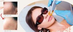 لیزر موهای زائد صورت