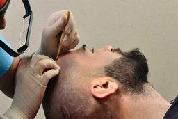 بهترین کلینیک کاشت مو در تهران 1402