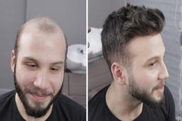 کلینیک کاشت مو در تهران