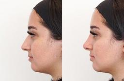 بهترین دکتر لیفت بینی با نخ در رشت + تجربه شخصی من