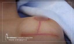 ماندگاری جای بخیه بعد از ماموپلاستی