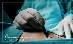 ممانعت از اب آوردن شکم پس از لیپوماتیک