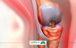 درمان سریع زانودرد درخانه؛ کاهش سریع سمت راست زانو