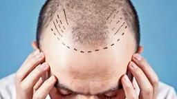 راهنمایی برای انتخاب بهترین کلینیک کاشت مو