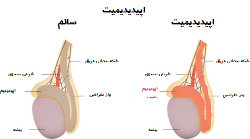 عوارض کیست بیضه