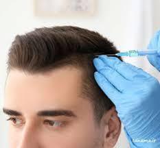 مزوتراپی جهت افزایش موی سر