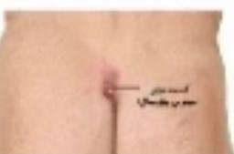 سینوس پیلونیدال ( مو برگشتگی )