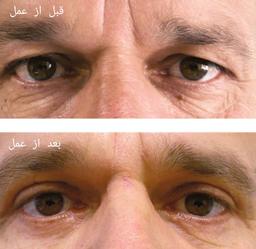 بلفاروپلاستی فوقانی ( جراحی زیبایی پلک فوقانی)