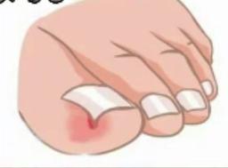 ناخن فرو رفته در گوشت ( کشیدن ناخن )