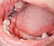 ملاحظات بعد از جراحی دندان