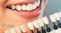 مزایا و عوارض لمینت دندان