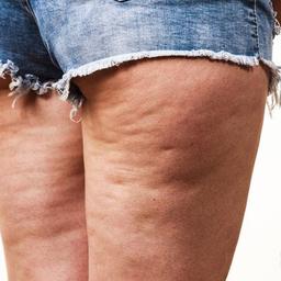 سلولیت چیست