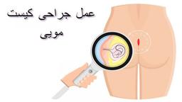 عمل جراحی کیست مویی به روش بسته و باز