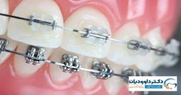 راهنمای انتخاب دکتر ارتودنسی در تهران
