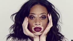 درمان برص یا پیسی یا ویتیلیگو دکتر روازاده