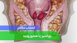 انتخاب دکتر خوب چه نقشی در درمان هموروئید دارد؟