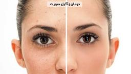 راه‌های درمان زگیل صورت; دلایل و انواع زگیل روی صورت