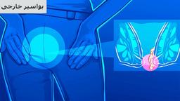 بواسیر خارجی چیست و برای درمان آن چکار کنیم؟