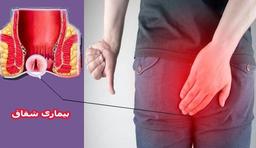 تفاوت شقاق حاد و مزمن و گزینه‌های درمان این بیماری