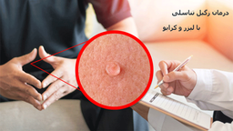 آشنایی با زگیل تناسلی و راه‌های درمان این بیماری