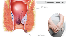 بواسیر یا هموروئید خارجی چیست و چگونه درمان می‌شود؟