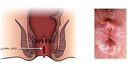 شقاق یا زخم مقعدی چیست؟ روش درمان قطعی با هزینه مناسب