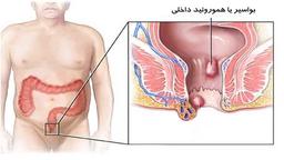 بواسیر داخلی، علائم هموروئید درجه 4،3،2،1 و راه درمان