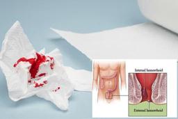 علائم بواسیر خونی و بهترین روش‌های درمان این بیماری