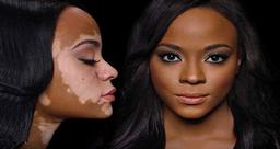 لک و پیس چیست و چگونه درمان می‌شود؟