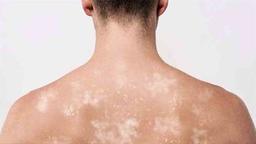 لکه های سفید قارچی روی پوست