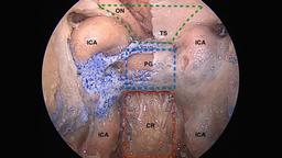جراحی اندوسکوپی تومور هیپوفیز چیست