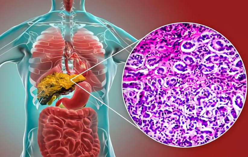 آیا سیروز کبدی سرطان است؟ 