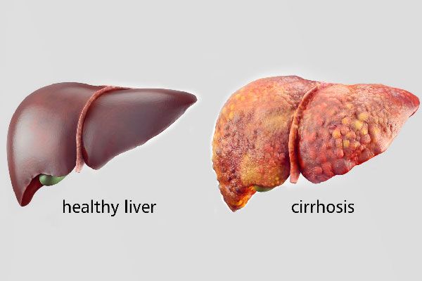 آیا سیروز کبدی سرطان است؟ 