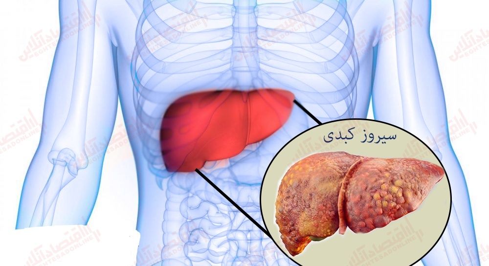 سیروز کبدی چگونه تشخیص داده میشود؟