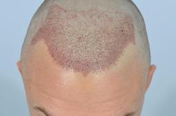 کاشت طبیعی موی سر با موهای بدن