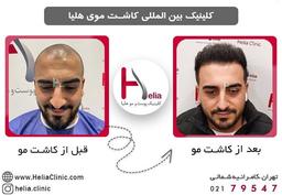 هزینه کاشت مو در کلینیک هلیا - در سال 1401