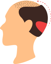 بانک مو مناسب برای عمل پیوند مو چقدر است؟