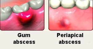 Periodontal Abscess versus Periapical Abscess