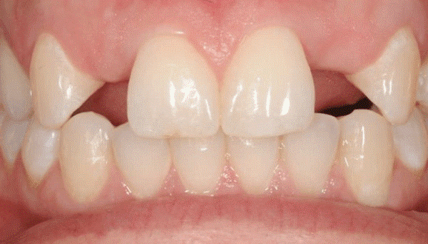 Phot description: a picture of human teeth with Hypodontia, the developmental absence of one or more teeth