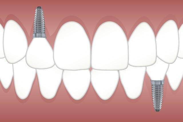 this picture depicts front tooth implant