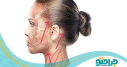 لیفت صورت و روش های انجام آن