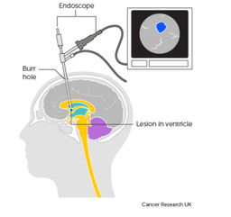 جراحی تومور های مغزی ( جراحی در بیداری و بدون بیهوشی )