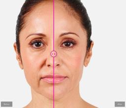 تاثیر تزریق [فیلر خط خنده] بر رفع خطوط اطراف لب