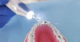 راهنمای جامع خرید دستگاه جرمگیر دندانپزشکی