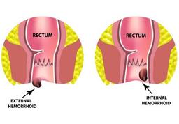 علائم بواسیر یا هموروئید خارجی ترومبوزه