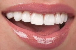 می خوای دندوناتو لمینت کنی؟ این نکات رو باید بدونی