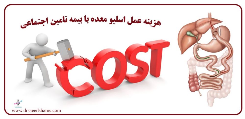 هزینه عمل اسلیو