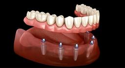 شایط پرداخت اقساط برای کاشت پر هزینه ایمپلنت دندان